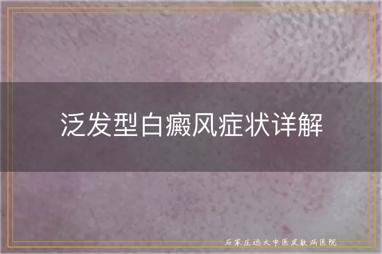 泛发型白癜风症状详解