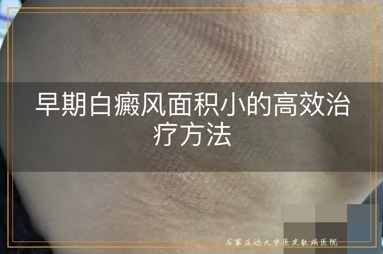 早期白癜风面积小的高效治疗方法