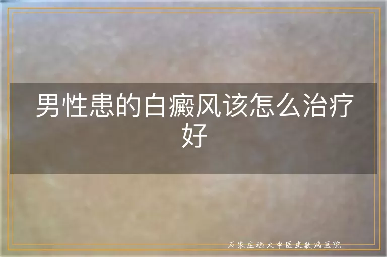 男性患的白癜风该怎么治疗好