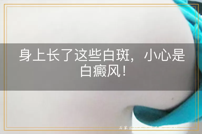 身上长了这些白斑，小心是白癜风！