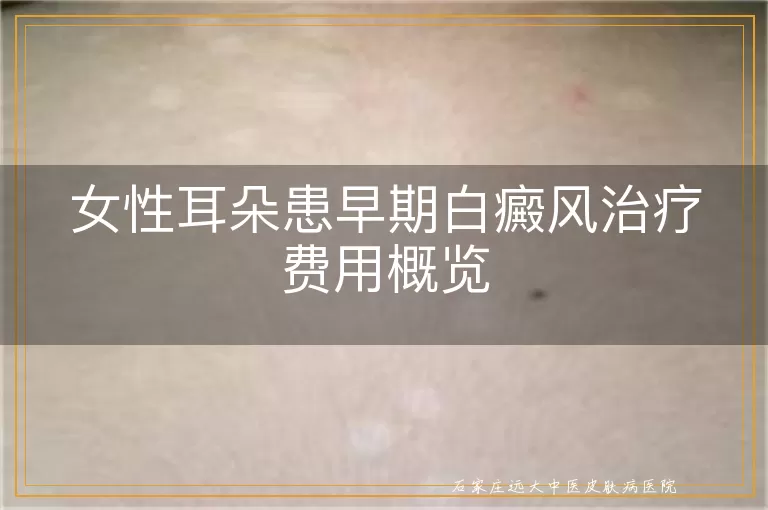 女性耳朵患早期白癜风治疗费用概览