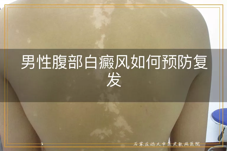 男性腹部白癜风如何预防复发