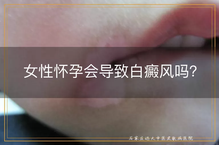 女性怀孕会导致白癜风吗？