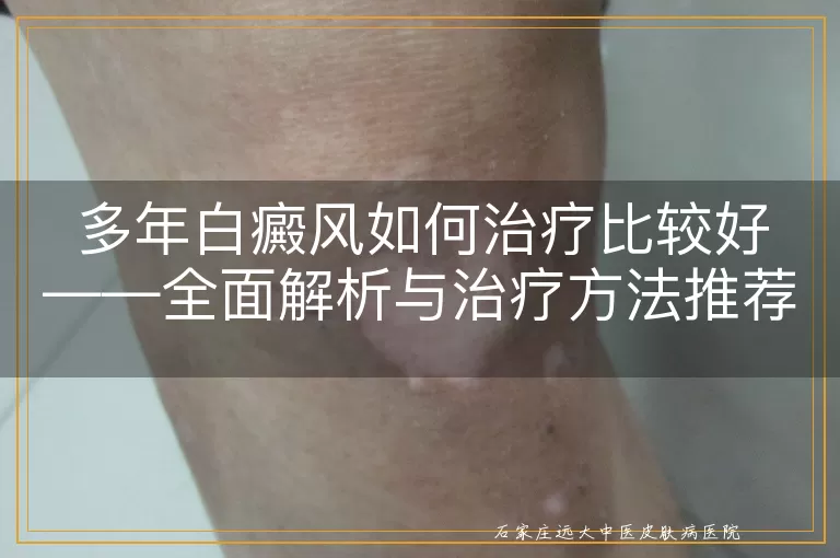 多年白癜风如何治疗比较好——全面解析与治疗方法推荐