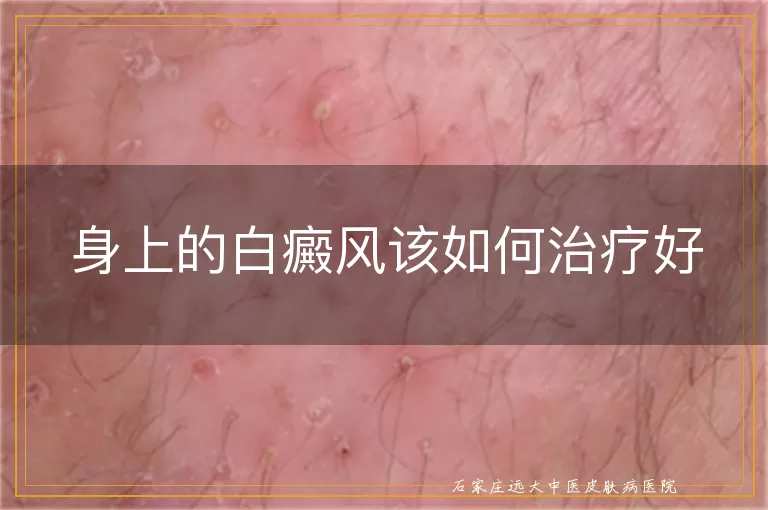 身上的白癜风该如何治疗好