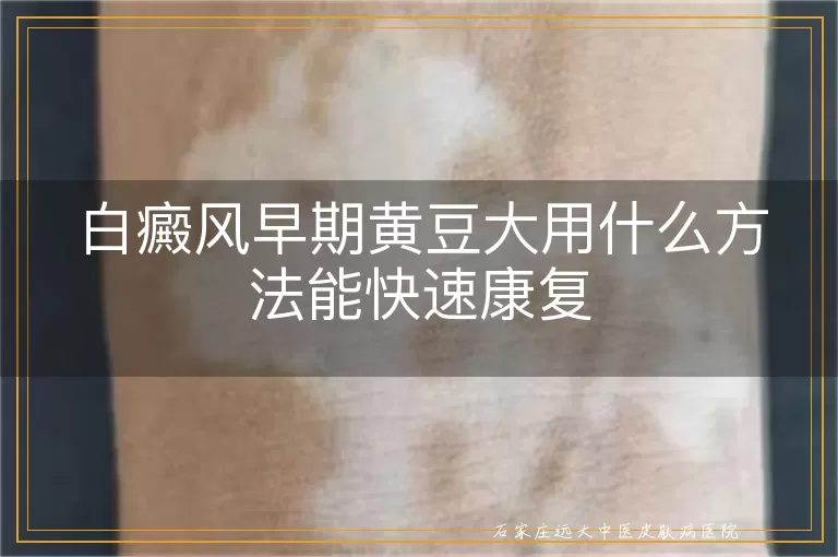 白癜风早期黄豆大用什么方法能快速康复