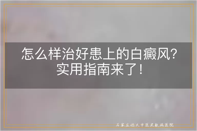 怎么样治好患上的白癜风？实用指南来了！