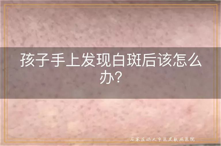 孩子手上发现白斑后该怎么办？