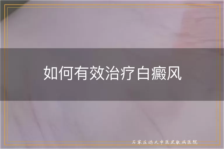 如何有效治疗白癜风