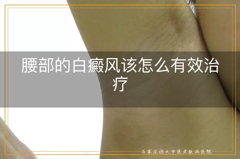 腰部的白癜风该怎么有效治疗