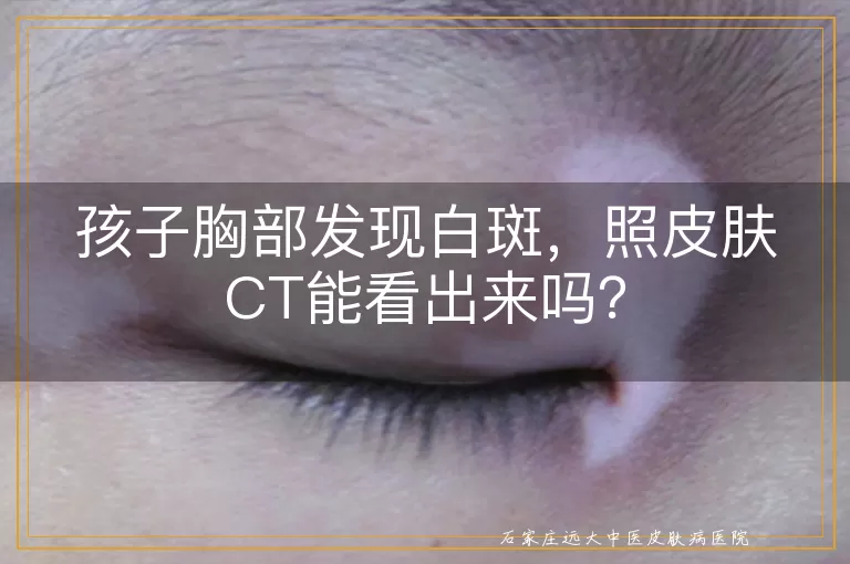 孩子胸部发现白斑，照皮肤CT能看出来吗？