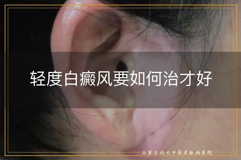 轻度白癜风要如何治才好