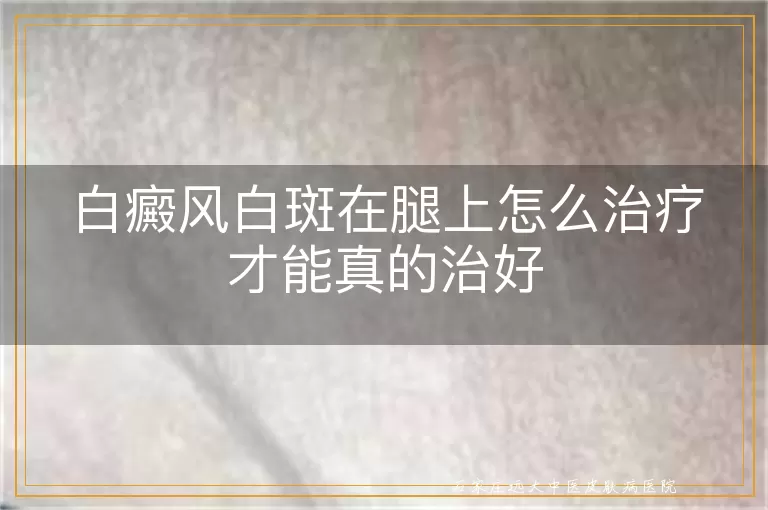 白癜风白斑在腿上怎么治疗才能真的治好