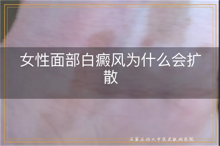 女性面部白癜风为什么会扩散