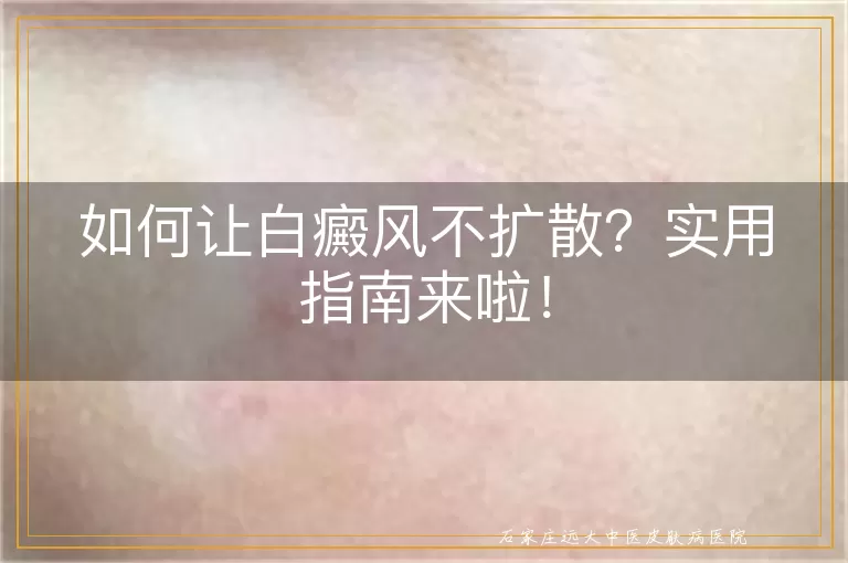 如何让白癜风不扩散？实用指南来啦！