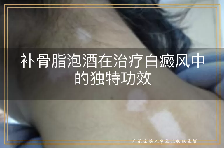 补骨脂泡酒在治疗白癜风中的独特功效