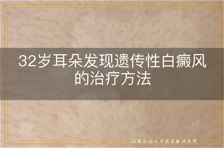 32岁耳朵发现遗传性白癜风的治疗方法