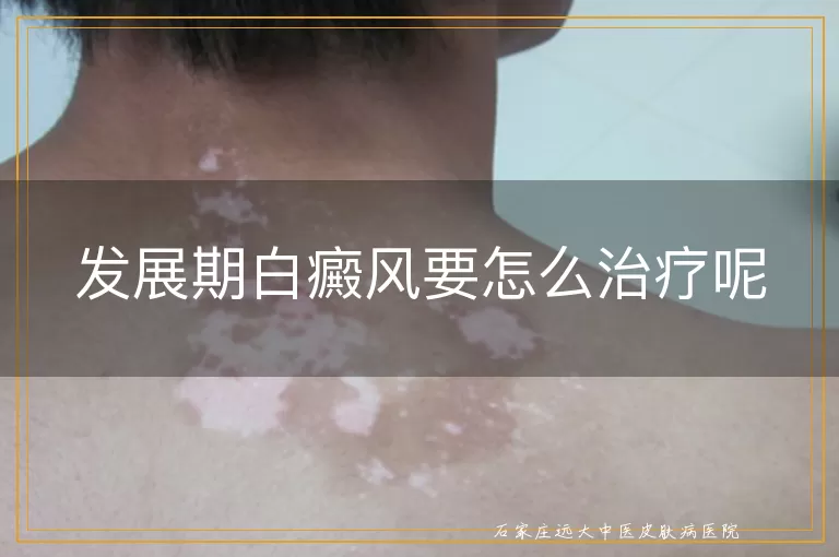 发展期白癜风要怎么治疗呢