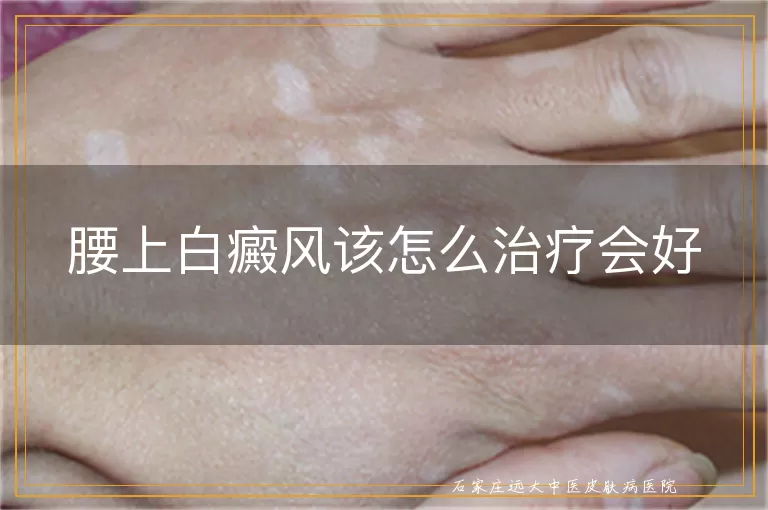 腰上白癜风该怎么治疗会好