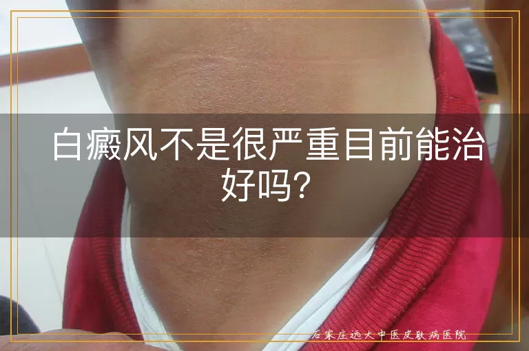 白癜风不是很严重目前能治好吗？