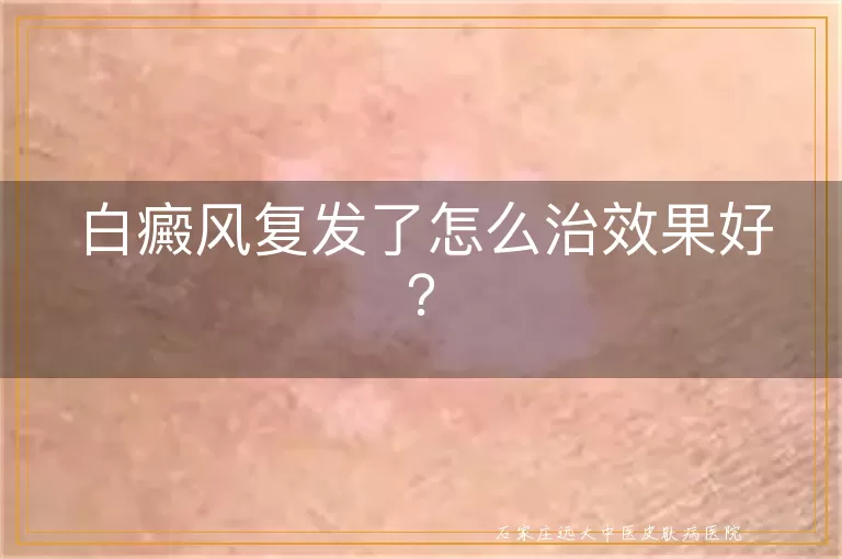 白癜风复发了怎么治效果好？