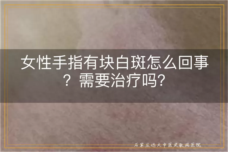 女性手指有块白斑怎么回事?需要治疗吗?