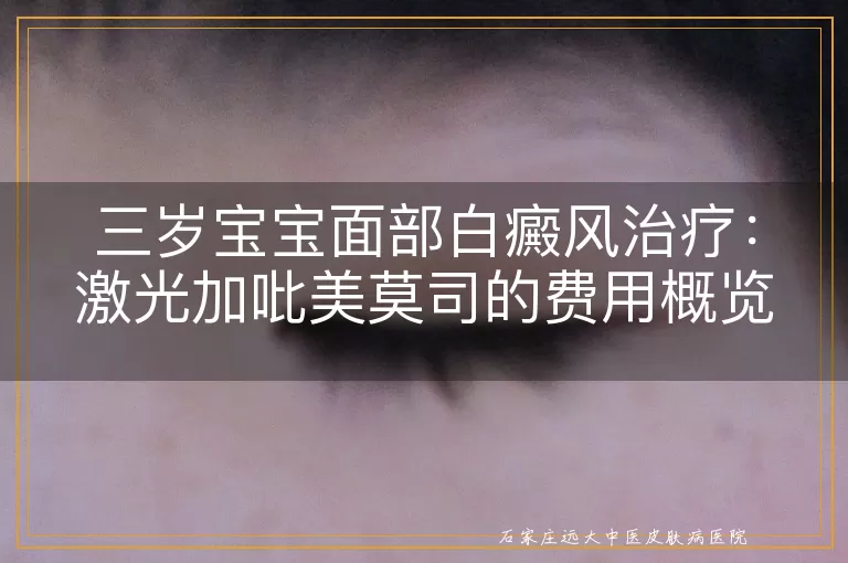 三岁宝宝面部白癜风治疗：激光加吡美莫司的费用概览