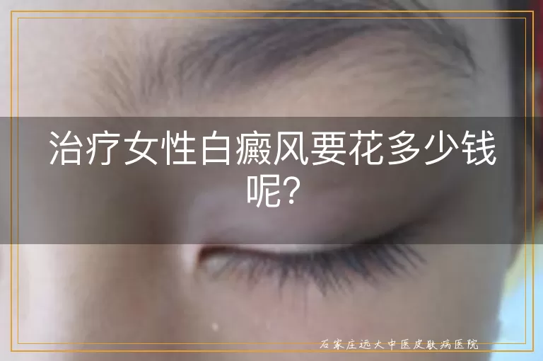 治疗女性白癜风要花多少钱呢？