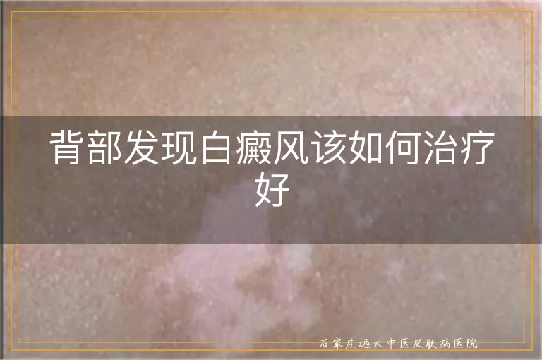 背部发现白癜风该如何治疗好