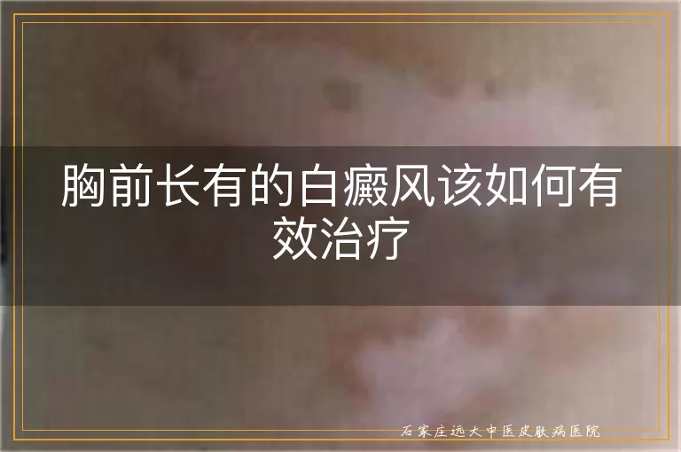 胸前长有的白癜风该如何有效治疗