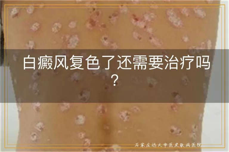 白癜风复色了还需要治疗吗？
