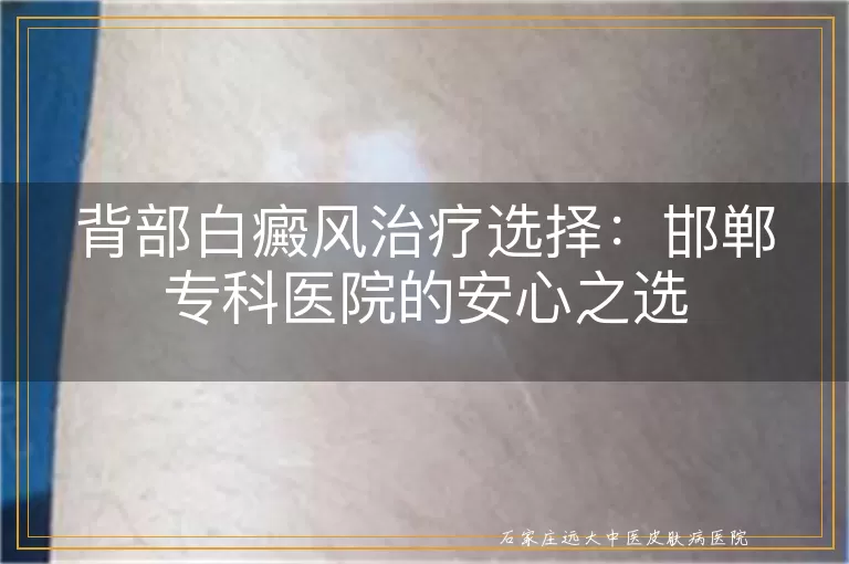 背部白癜风治疗选择：邯郸专科医院的安心之选