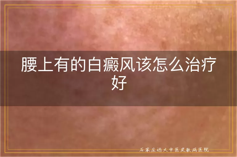 腰上有的白癜风该怎么治疗好