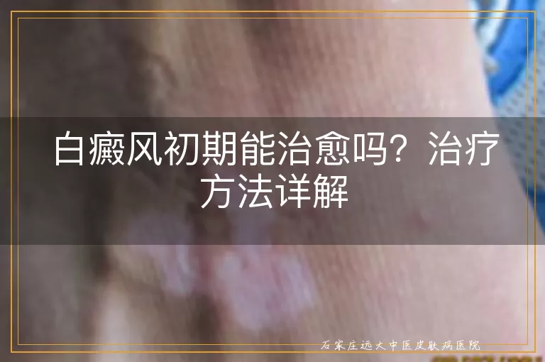白癜风初期能治愈吗？治疗方法详解