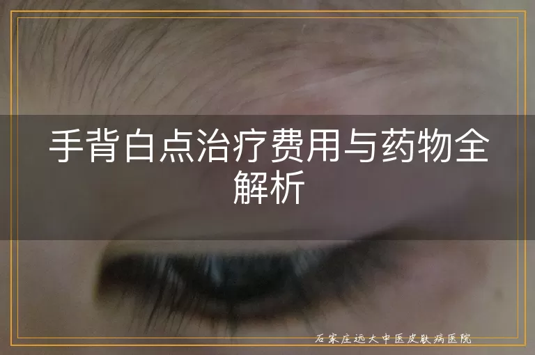 手背白点治疗费用与药物全解析