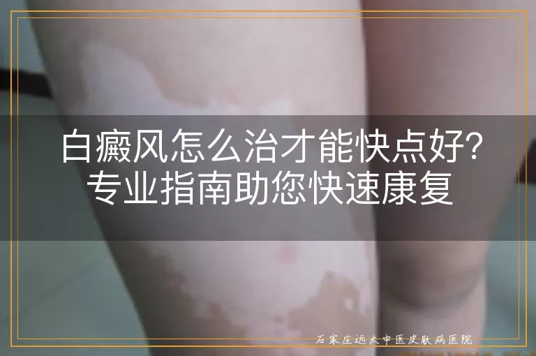 白癜风怎么治才能快点好?专业指南助您快速康复
