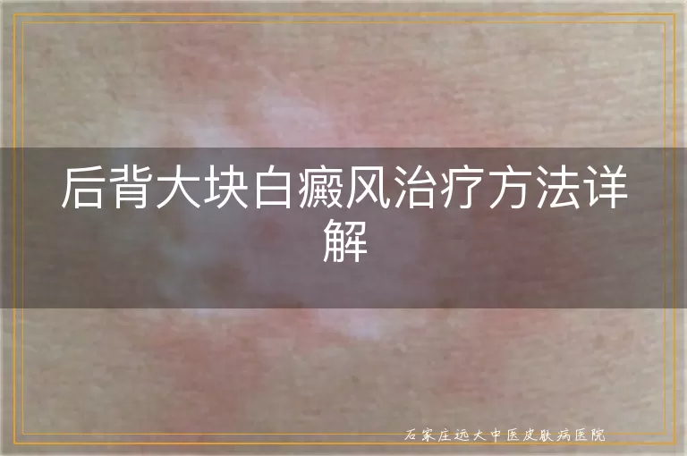 后背大块白癜风治疗方法详解