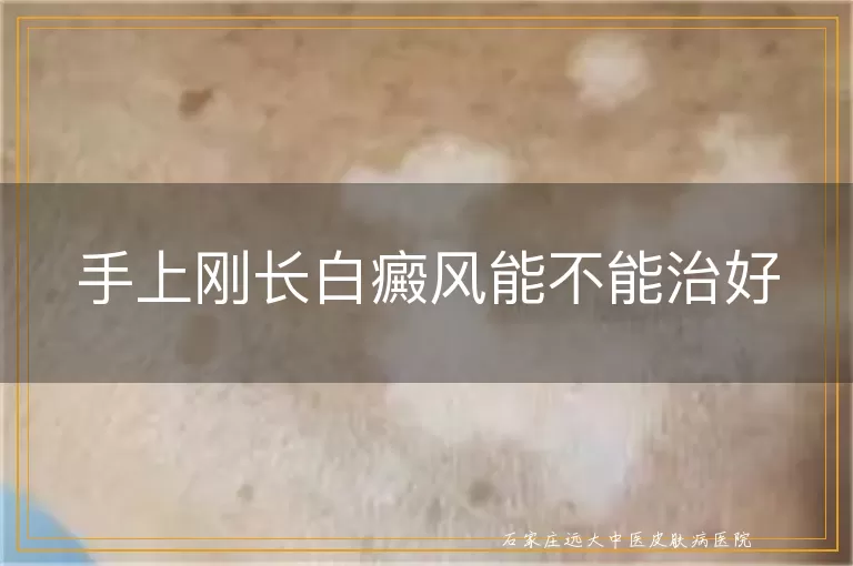 手上刚长白癜风能不能治好
