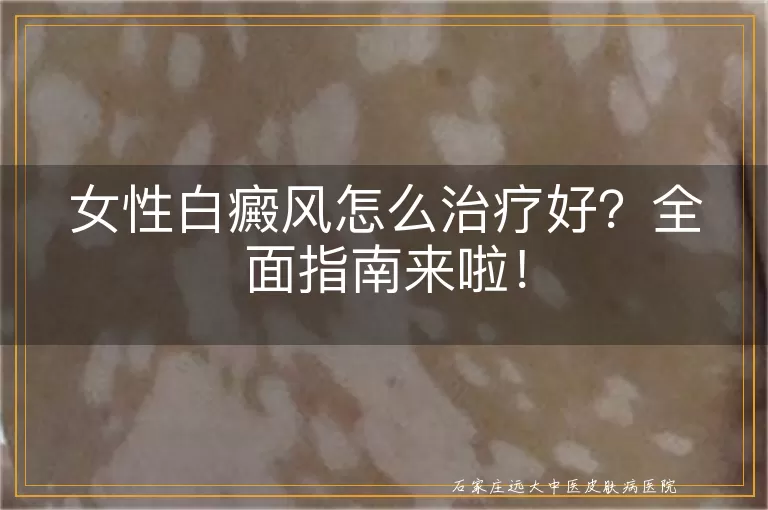 女性白癜风怎么治疗好？全面指南来啦！