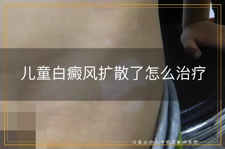 儿童白癜风扩散了怎么治疗