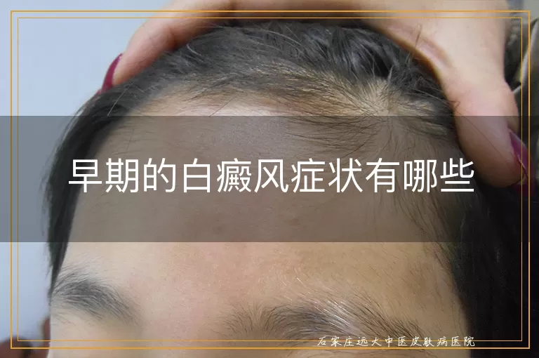 早期的白癜风症状有哪些