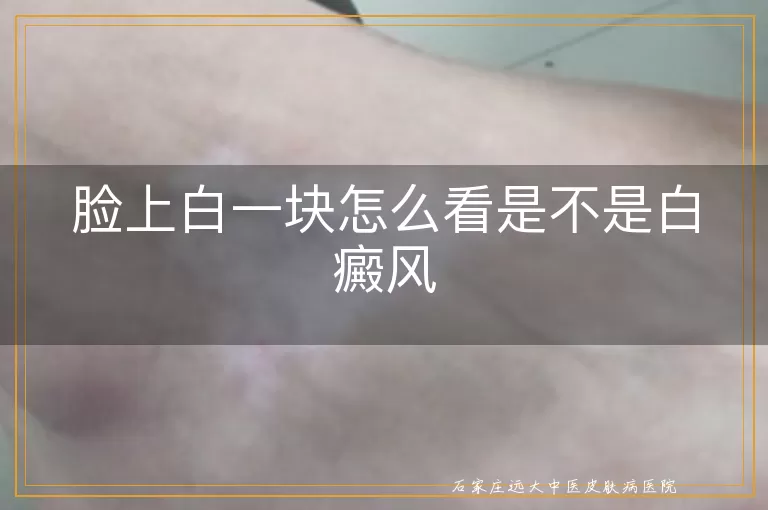 脸上白一块怎么看是不是白癜风