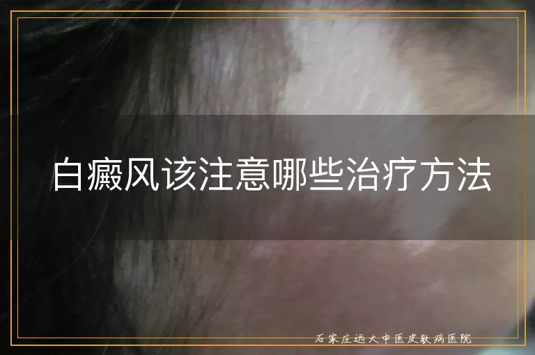 白癜风该注意哪些治疗方法