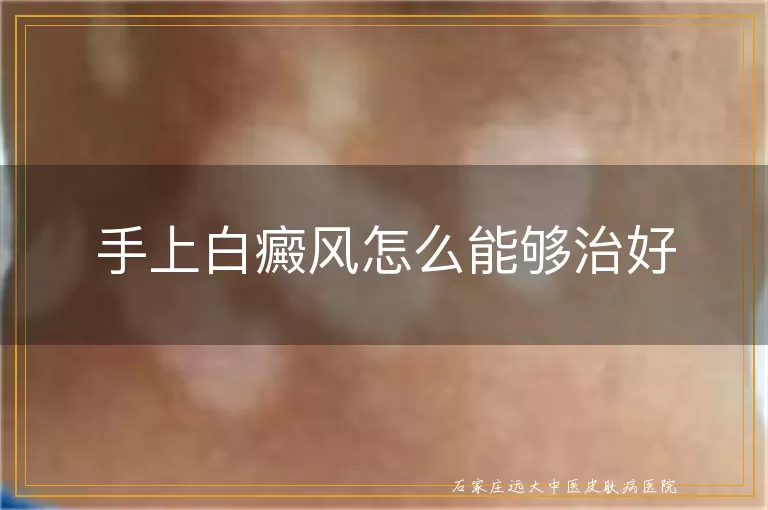 手上白癜风怎么能够治好