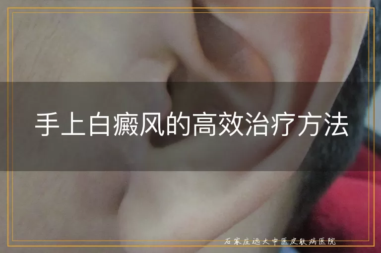 手上白癜风的高效治疗方法