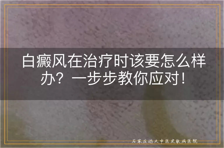 白癜风在治疗时该要怎么样办？一步步教你应对！