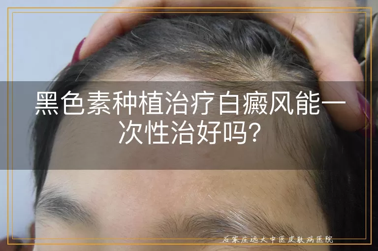 黑色素种植治疗白癜风能一次性治好吗？
