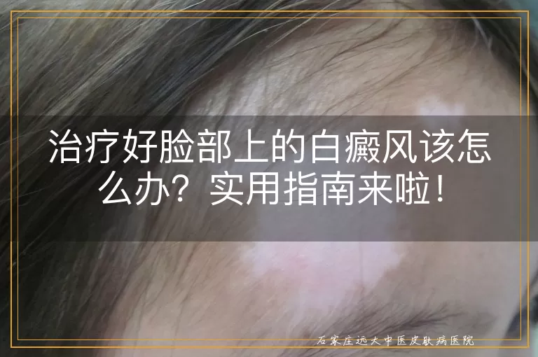 治疗好脸部上的白癜风该怎么办？实用指南来啦！