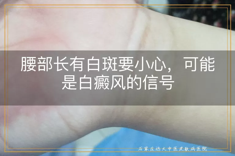腰部长有白斑要小心，可能是白癜风的信号
