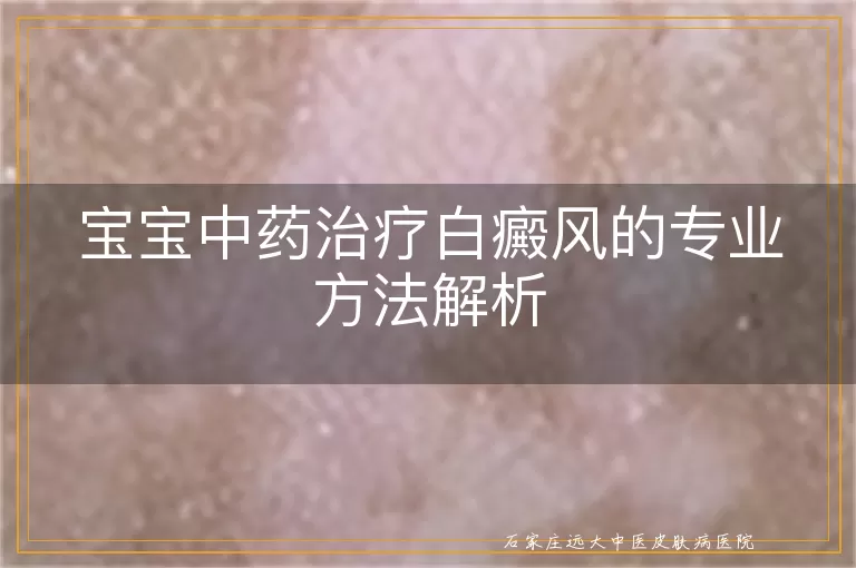 宝宝中药治疗白癜风的专业方法解析